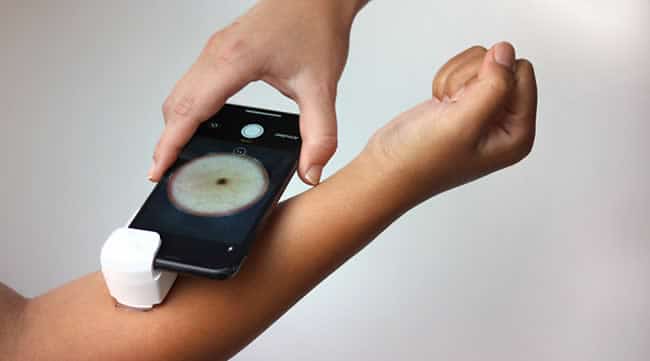 With a special device that's mounted on a smartphone dermatoscopic photos of solitary skin lesions can be made - source and more information